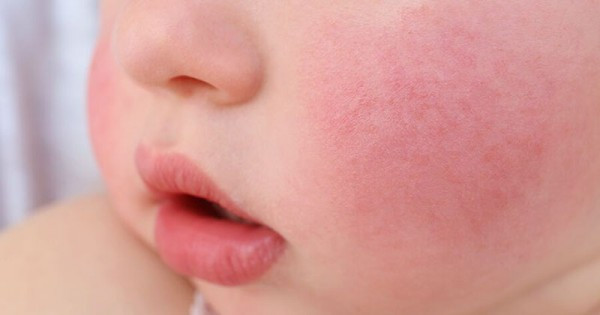 Erythema Infectiosum (Penyakit Kelima)